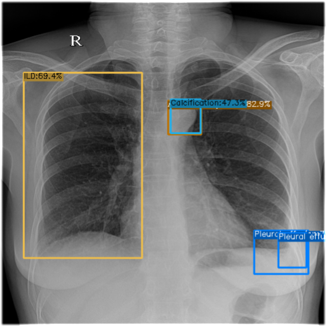 GitHub - bbonghag/Chest-X-ray-Object-Detection: DL/Object Detection project