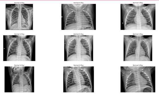 GitHub - dikshyathapa/Pneumonia-Detection-System-using-CNN: By using ...