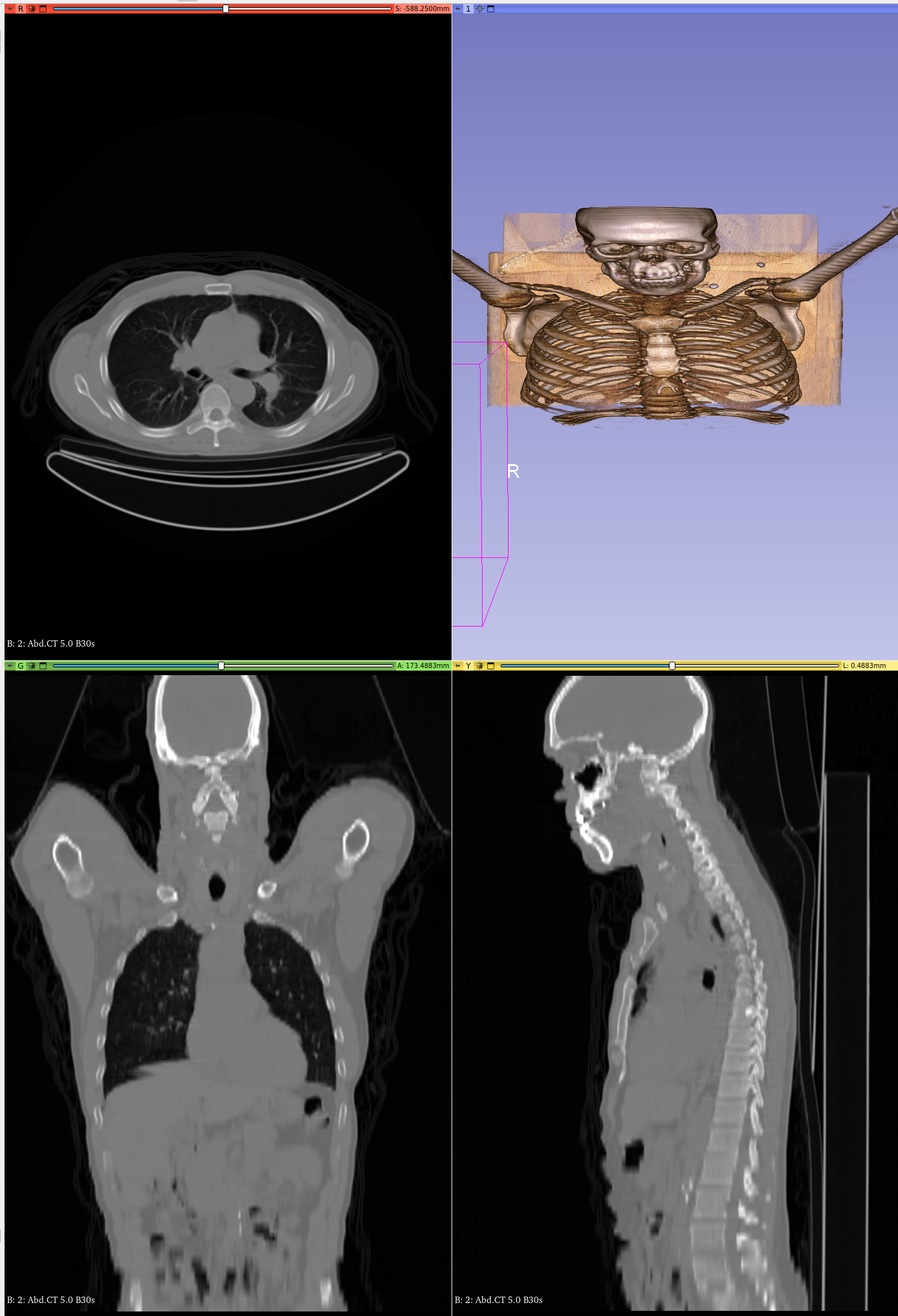 Support Inconsistent DICOM Image Spacing · Issue #291 · Kitware/VolView ...