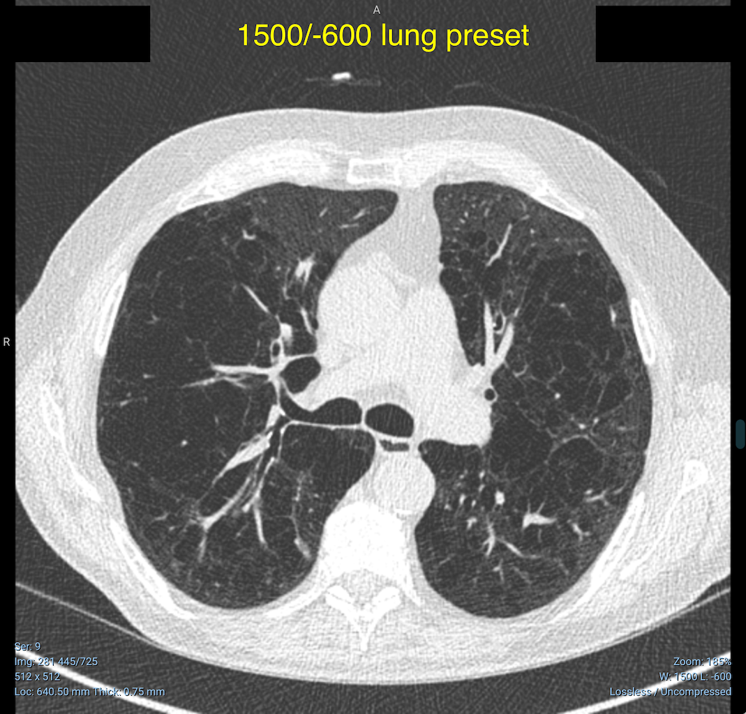 incorrect-default-preset-for-lung-window-level-issue-3177-ohif