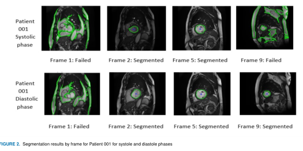 GitHub - ArozHada/lv_seg: Automatic segmentation of the left ventricle ...