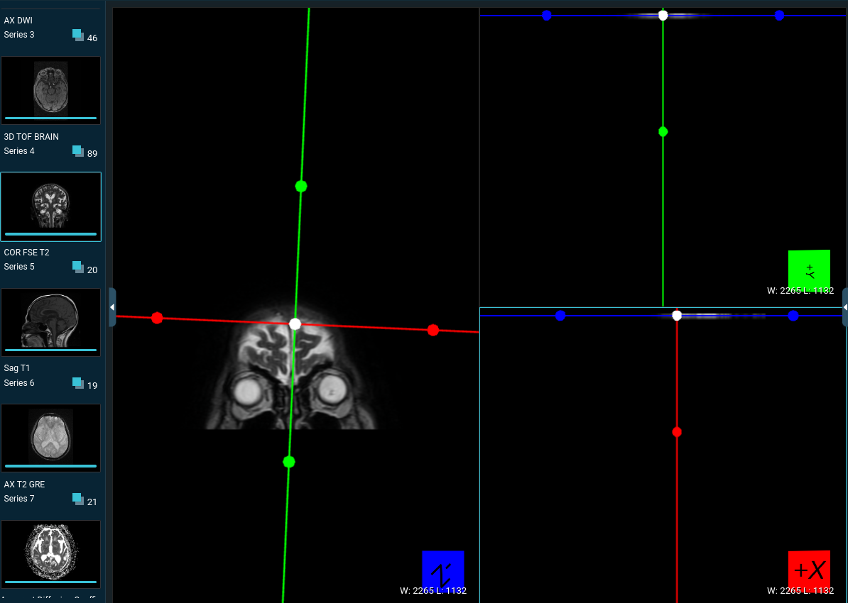 ImageReslice does not work properly with MRI · Issue #2557 · Kitware ...
