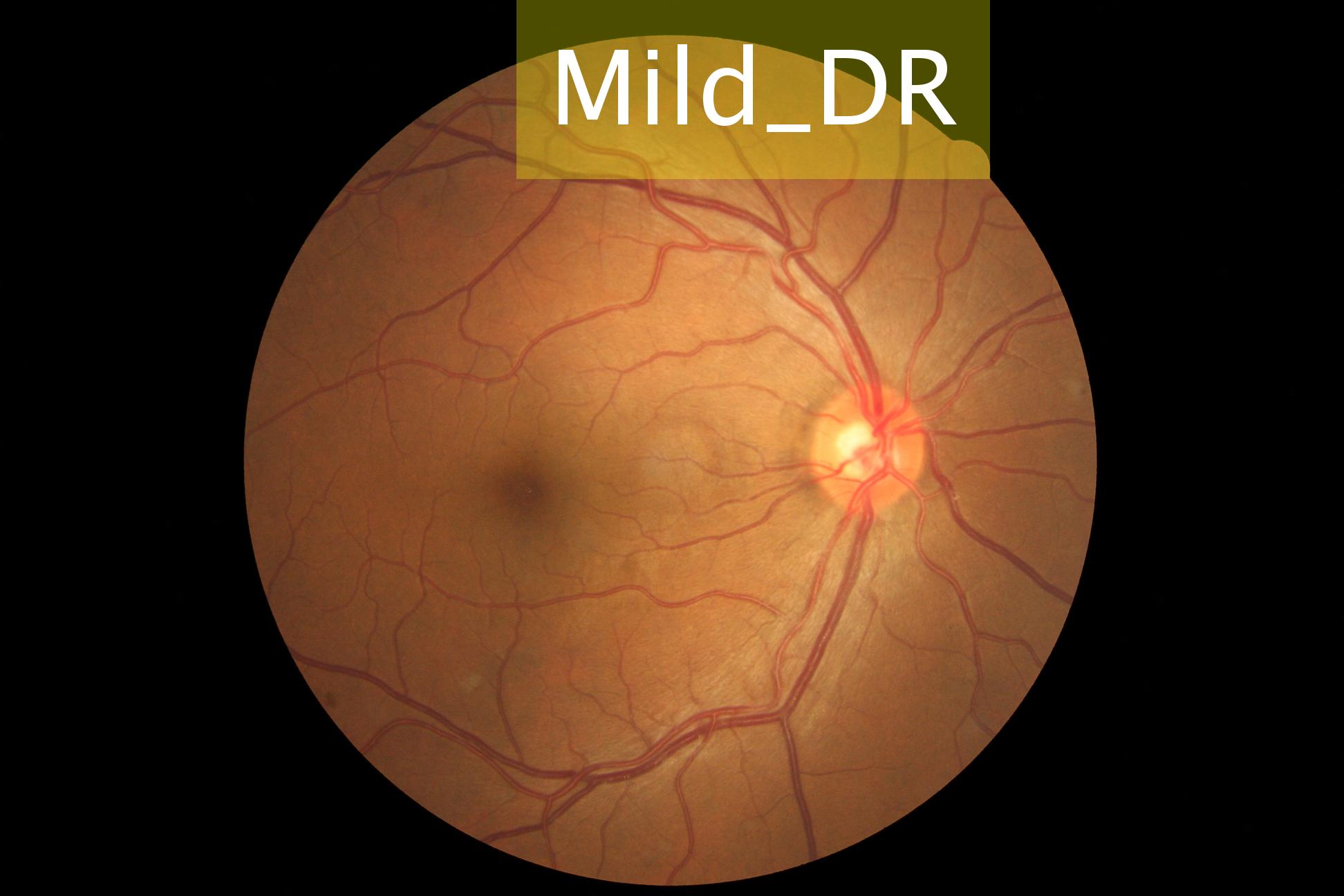 Mild_DR_Labeled_17_right