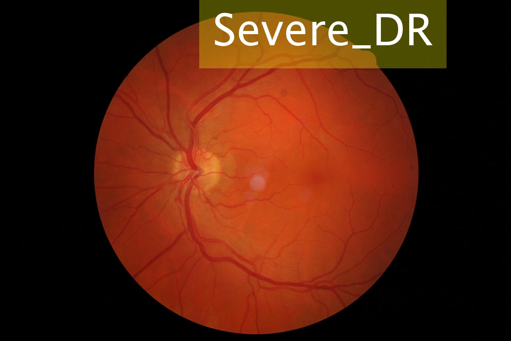 Severe_DR_Labeled_396_left