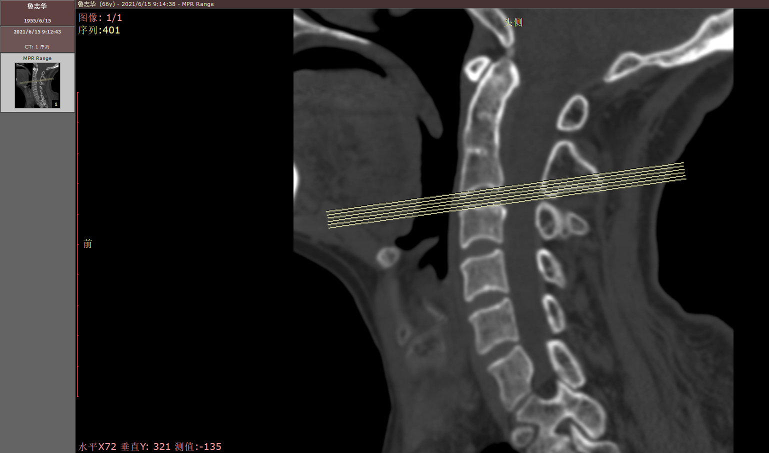 Dicom Reference Line My DICOM file doesn't show the location mark area of the ReferenceLines ...