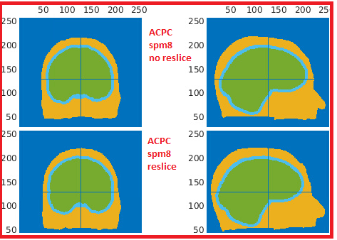 (inconsistent) artefacts and errors in ft_volumesegment with spm12 old ...