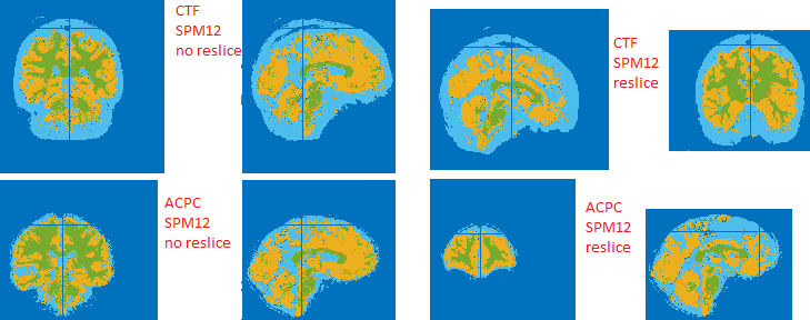 (inconsistent) artefacts and errors in ft_volumesegment with spm12 old ...