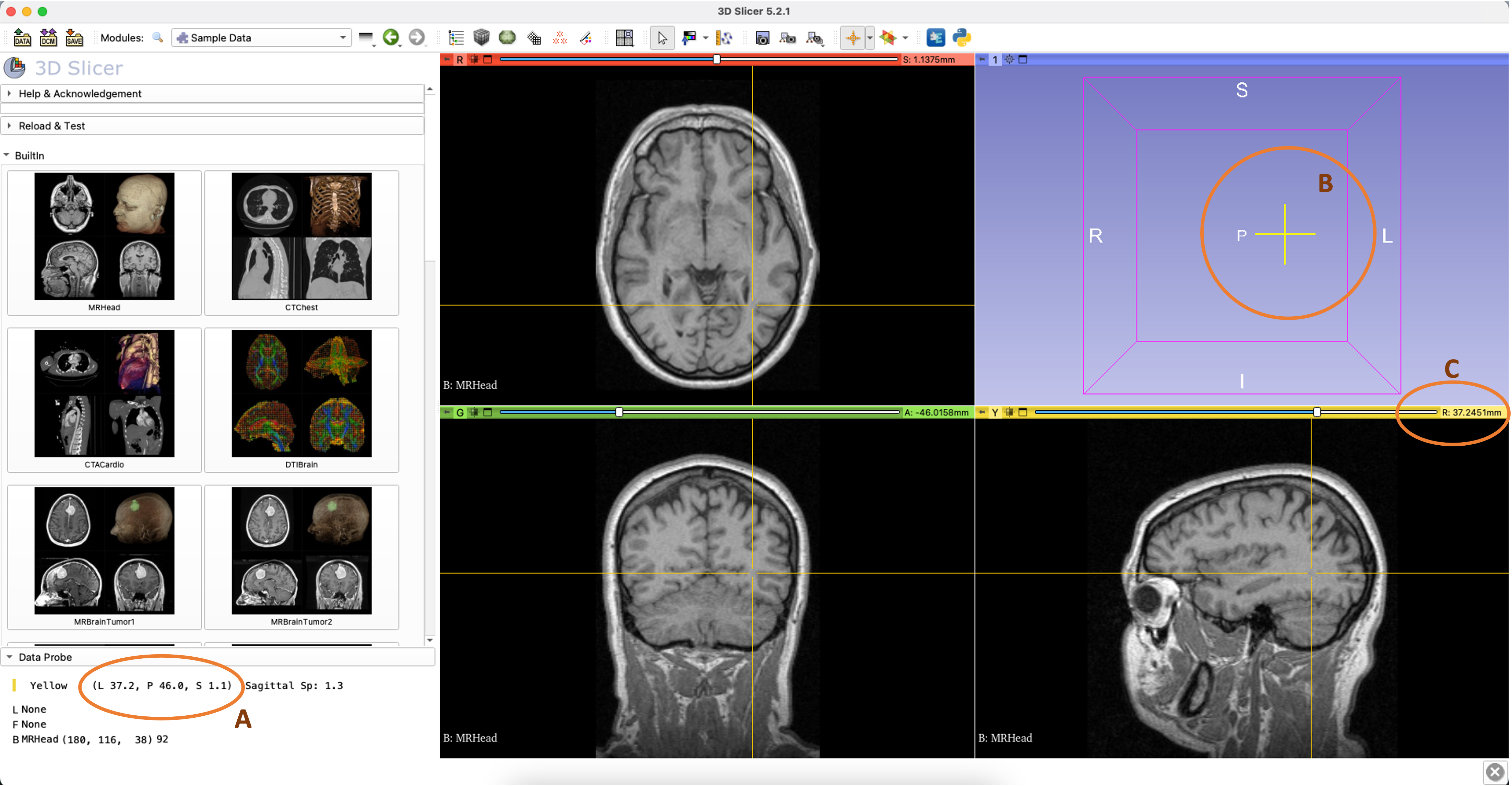 Sagittal slice view sign inverted · Issue #6778 · Slicer/Slicer · GitHub