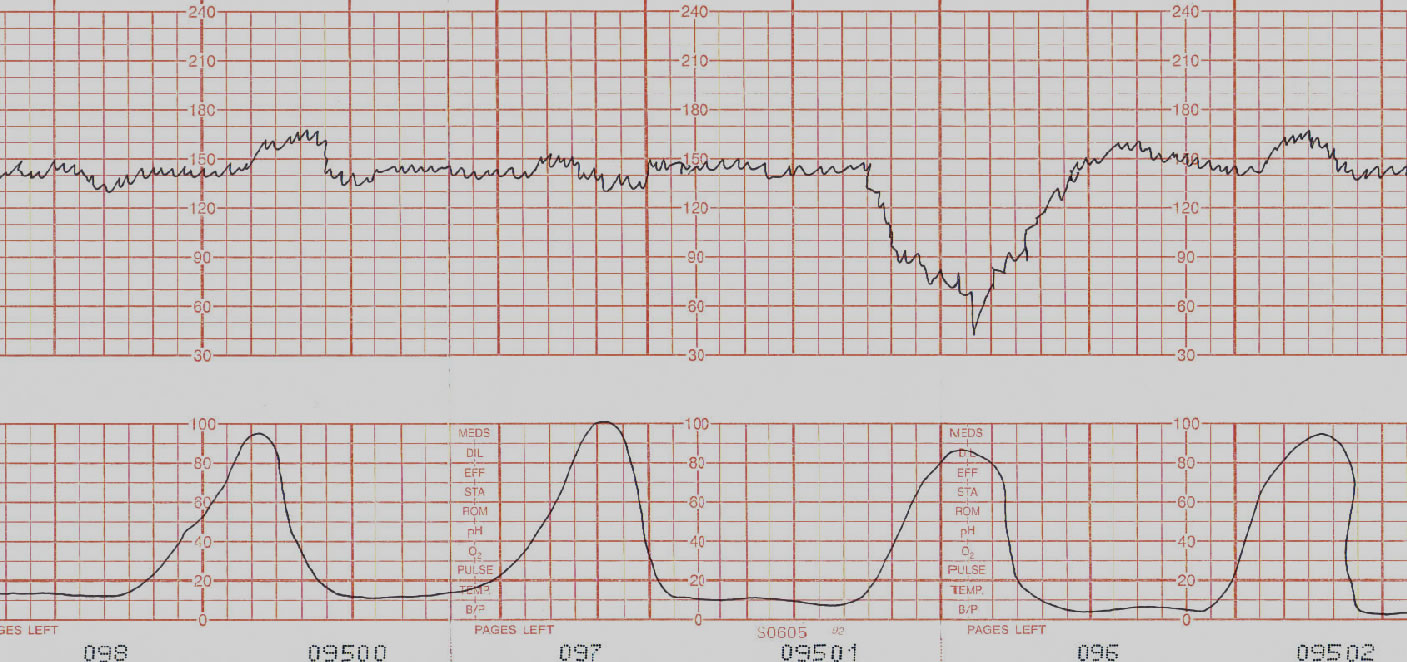 Deviceefm Implementation For Fetal Heart Monitor Issue 2 Tanjera Infirmary Integrated Github