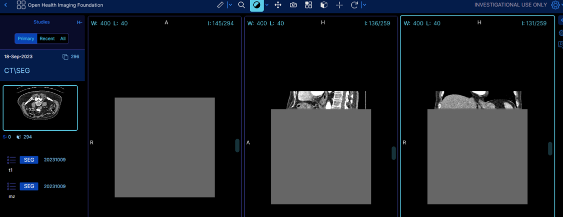 OHIF V3 MONAI Plugin: Some images stop loading · Issue #1565 · Project ...