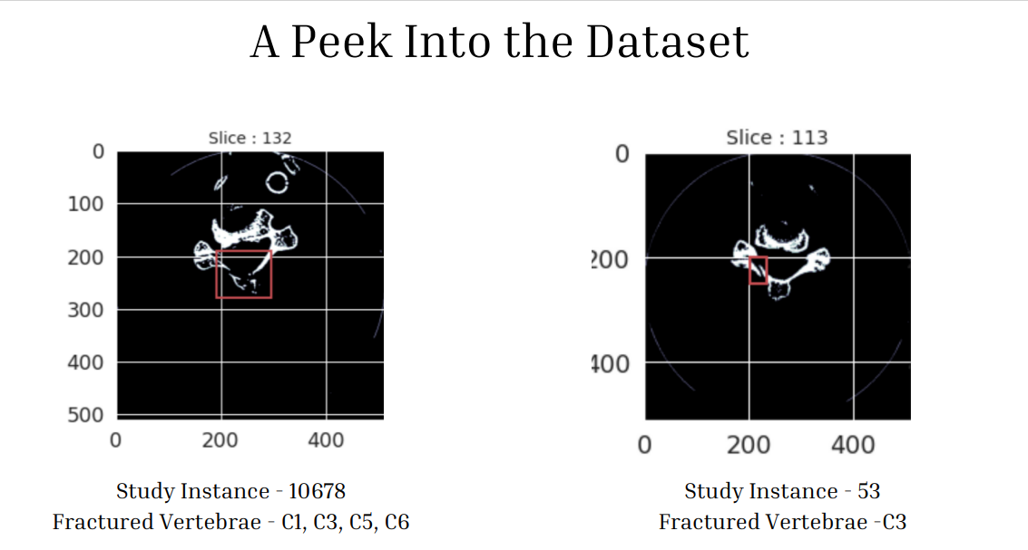 Github renita1206 bone fracture detection mi cs302 project