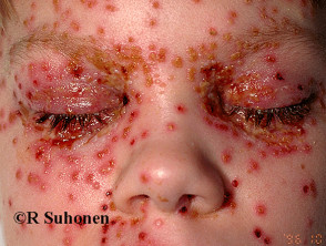 eczema1