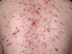 varicella4