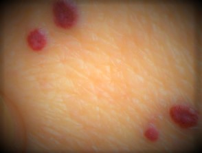 angioma1