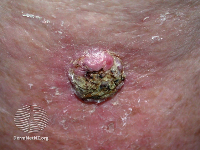 Squamous1
