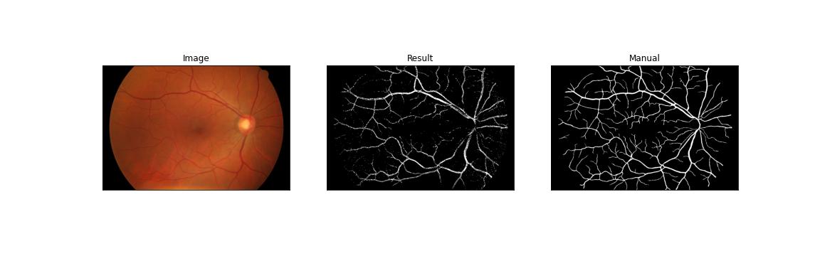 Github Wojtistudent Segmenting Retinal Blood Vessels Github Wojtistudent Segmenting Retinal Blood Vessels