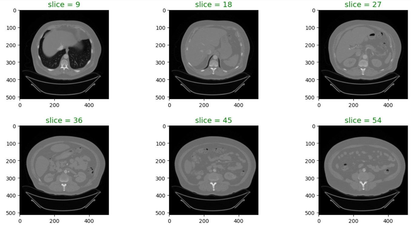 Github Pukhrajpatel Ct Scan Kidney Tumor Segmentation Github Pukhrajpatel Ct Scan Kidney Tumor Segmentation